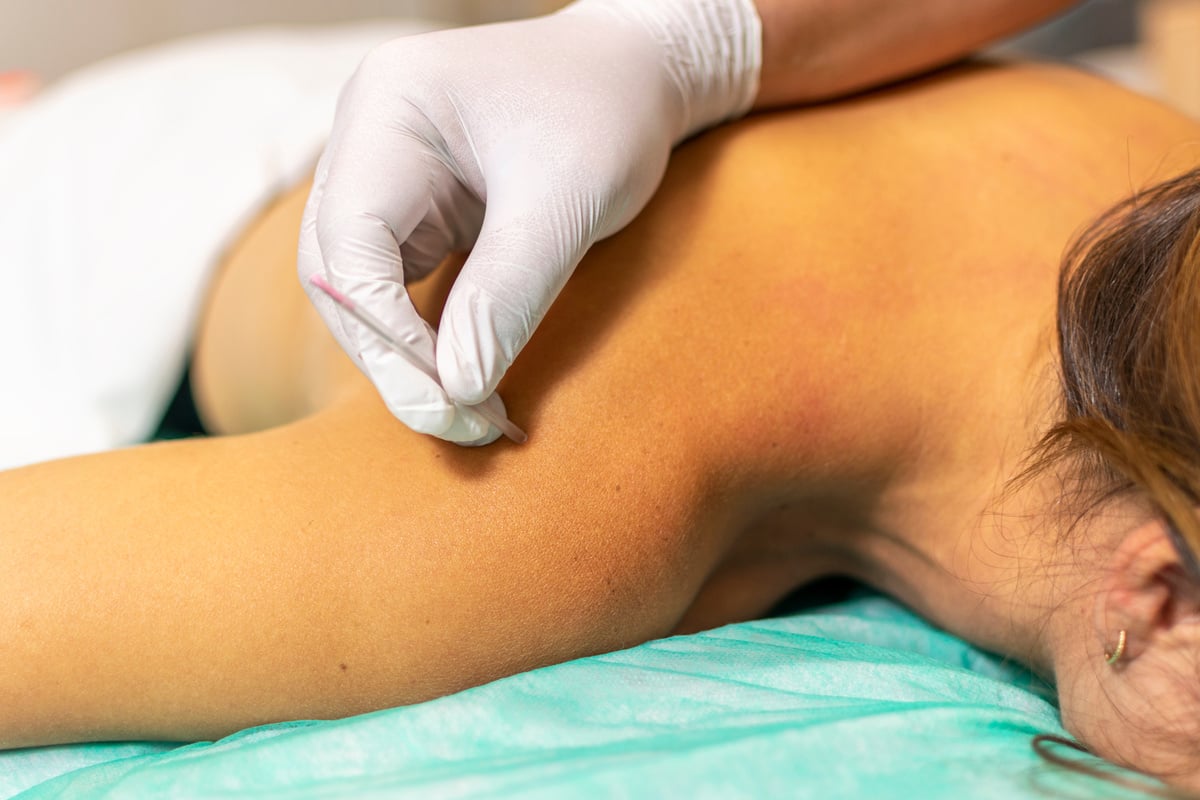 Woman Receiving a Dry Needling Treatment