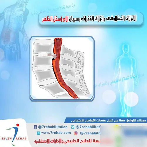 الانزلاق الغضلاوفى وانزلاق الفقرات يسببان آلام أسفل الظهر