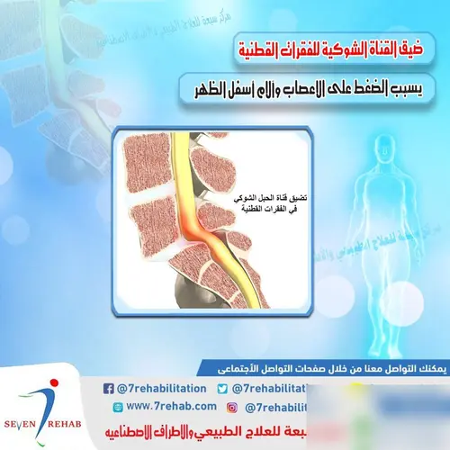 ضيق القناة الشوكية للفقرات القطنية يسبب الضغط على الاعصاب وآلام أسفل الظهر
