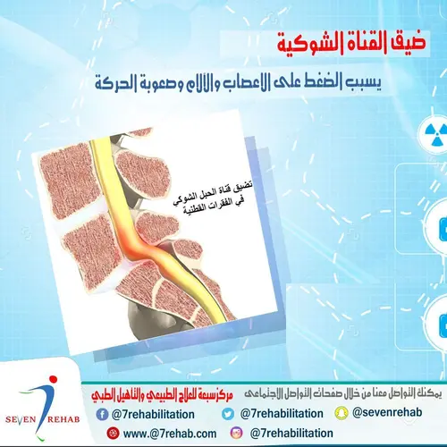 ضيق القناة الشوكية يسبب الضغط على الاعصاب والآلام وصعوبة الحركة