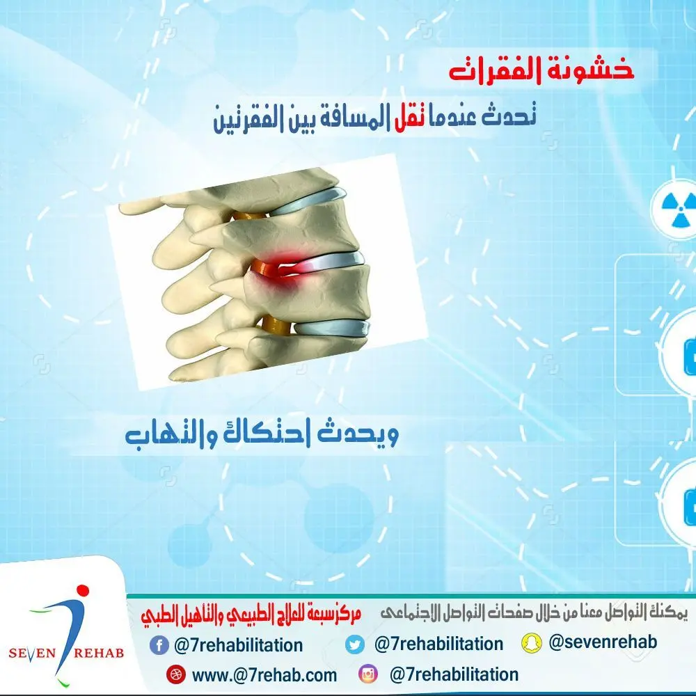 خشونة الفقرات تحدث من تقليل المسافة بين الفقرتين وحدوث احتكاك والتهاب