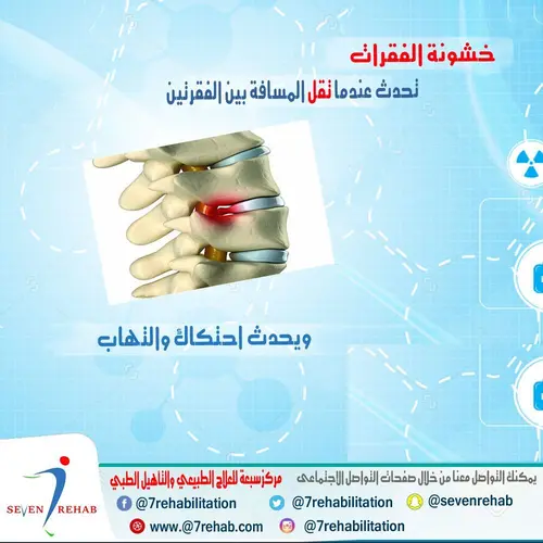 خشونة الفقرات تحدث عندما تقل المسافة بين الفقرتين ويحدث احتكاك والتهاب