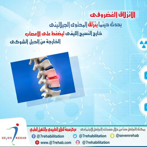 الانزلاق الغضروفى يحدث حينما ينزلق المحتوى الجيلاتينى خارج النسيج الليفى ليضغط على الاعصاي الخارجة من الحبل الحبل الشوكى