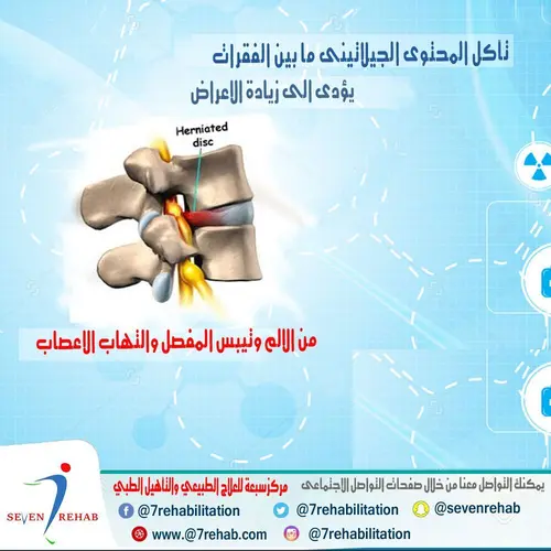 تآكل المحتوى الجيلاتينى وما بين الفقرات يؤدى الى زيادة الاعراض من الالم وتيبس المفصل والتهاب الاعصاب