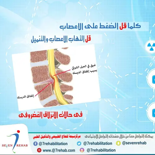 كلما قل الضغط على الاعصاب قل التهاب الاعصاب والتنميل فى حالات الانزلاق الغضروفى