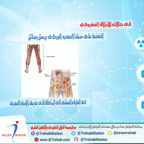 فى حالات الانزلاق الغضروفى الضغط على منشأ العصب الوركى يرسل رسائل فى الطرف السفلى الى المناطق التى يغذيها بالامداد العصبى