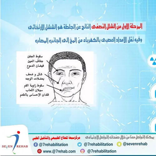 المرحلة الاول من الشلل النصفى الناتج عن الجلطة هو الشلل الارتخائى وفيه تقل  الامداد العصبى بالكهرباء من  المخ الى الجانب المصاب